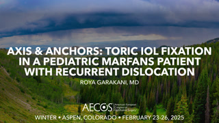 Axis & Anchors: Toric IOL fixation in a pediatric Marfan's patient with recurrent dislocation